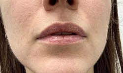 Lip Filler Before & After