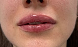 Lip Filler Before & After