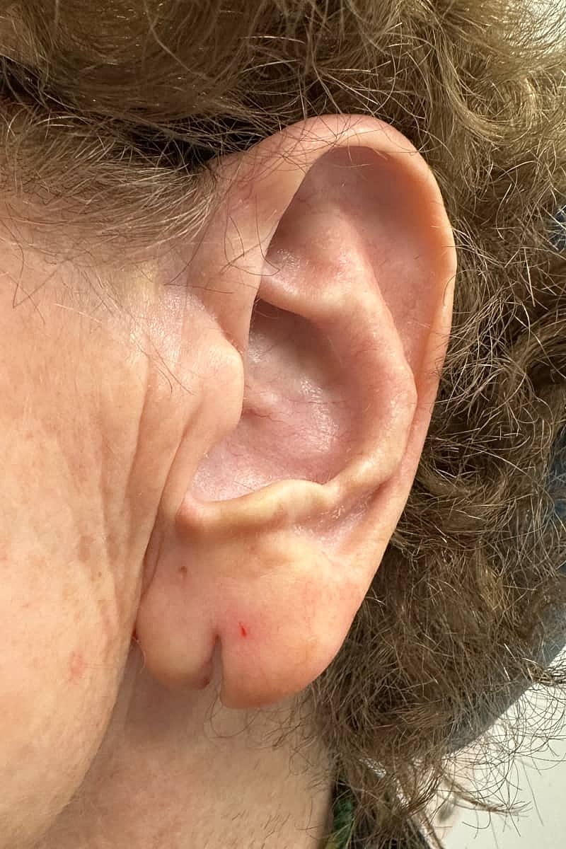 Earlobe Repair Before & After