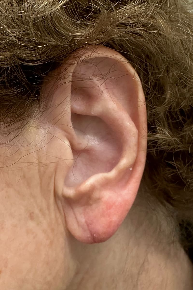 Earlobe Repair Before & After