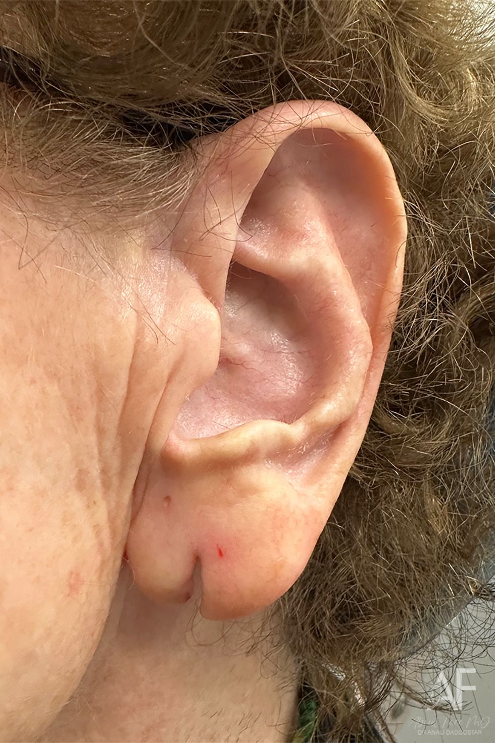 Earlobe Repair Before & After