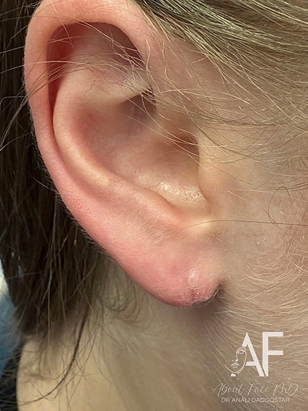 Earlobe Repair Before & After