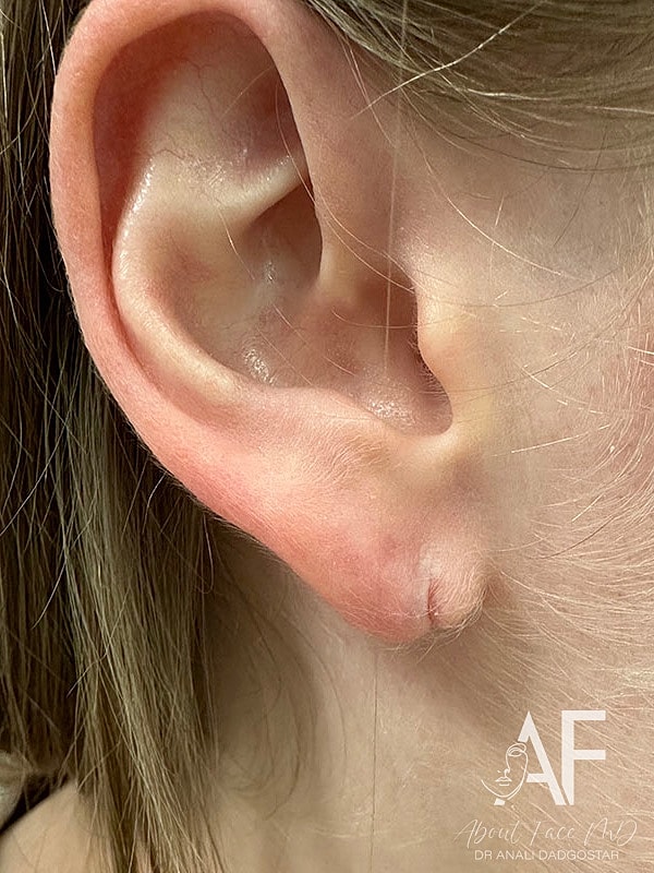 Earlobe Repair Before & After