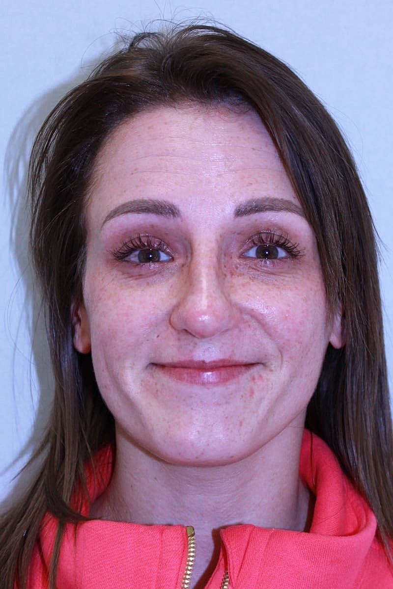 Botox/Neuromodulators Before & After