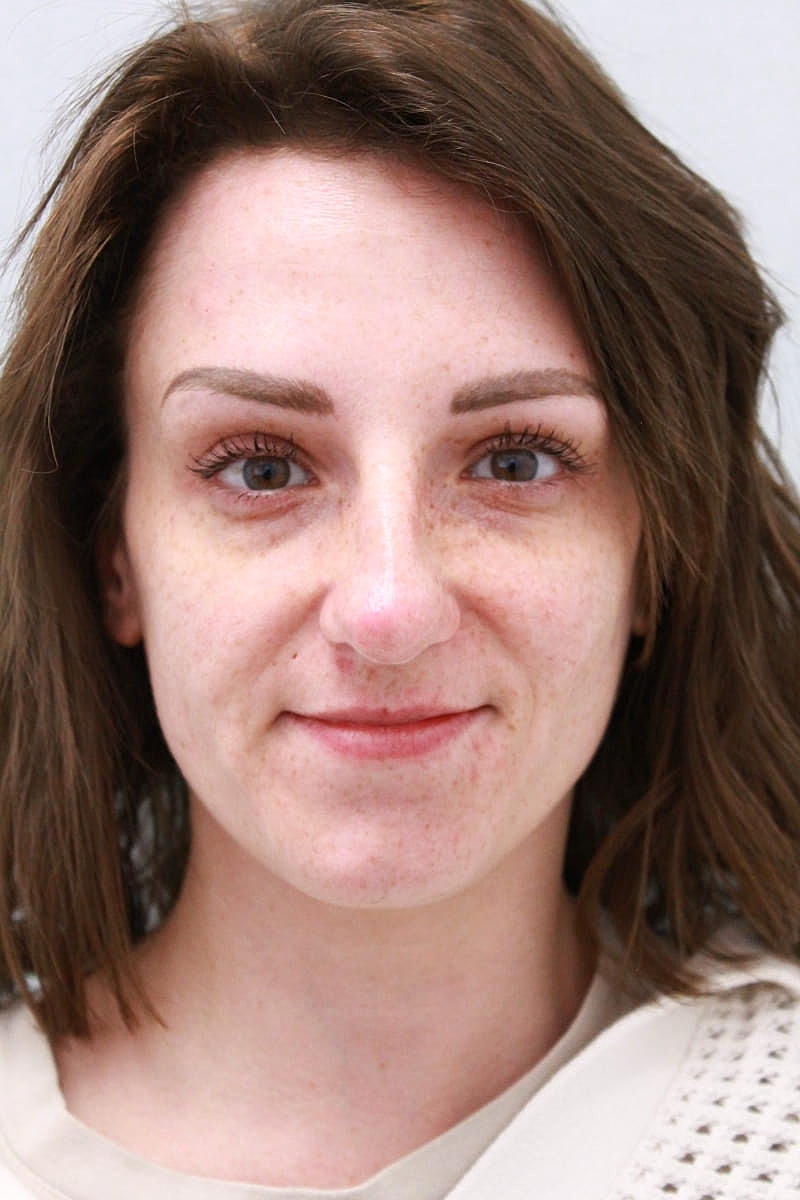 Botox/Neuromodulators Before & After