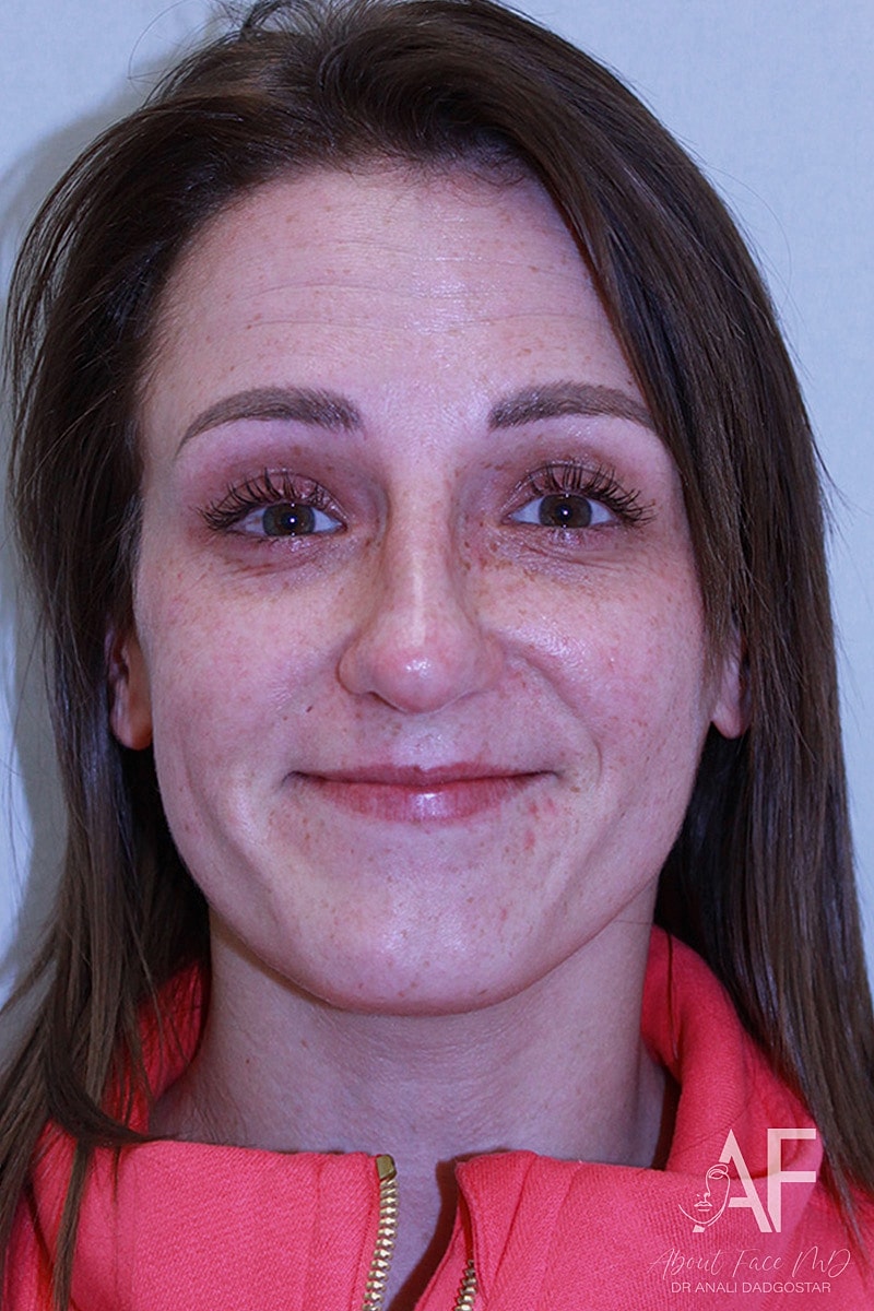 Botox/Neuromodulators Before & After