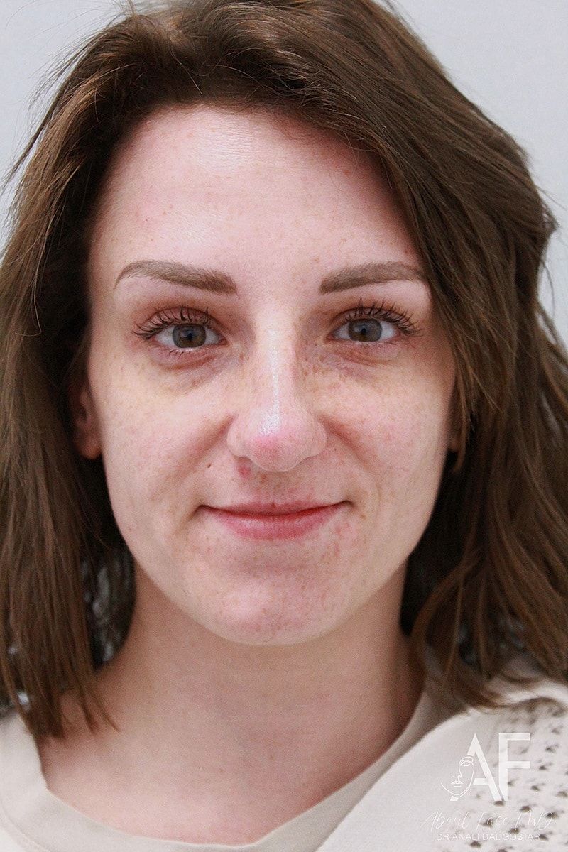 Botox/Neuromodulators Before & After