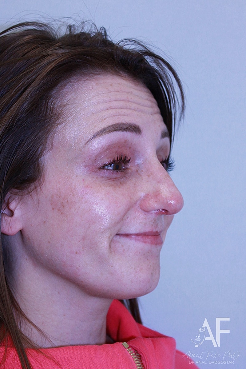 Botox/Neuromodulators Before & After