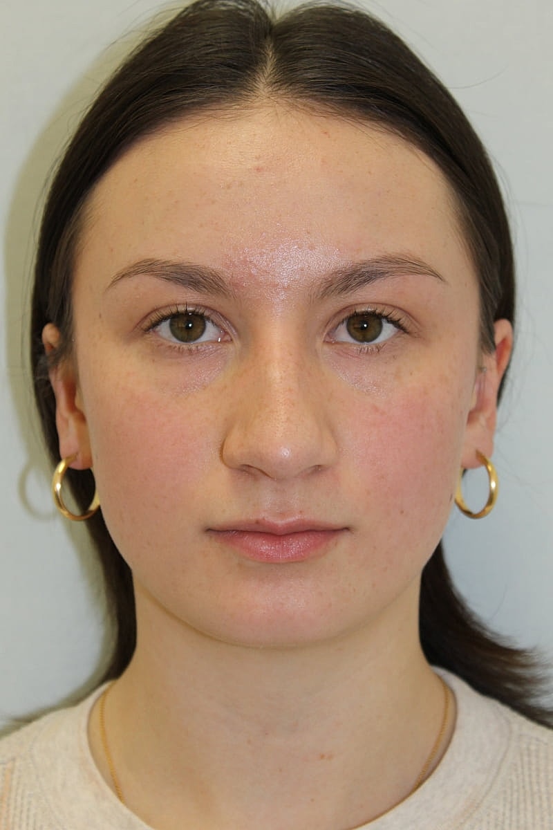 Rhinoplasty Before & After