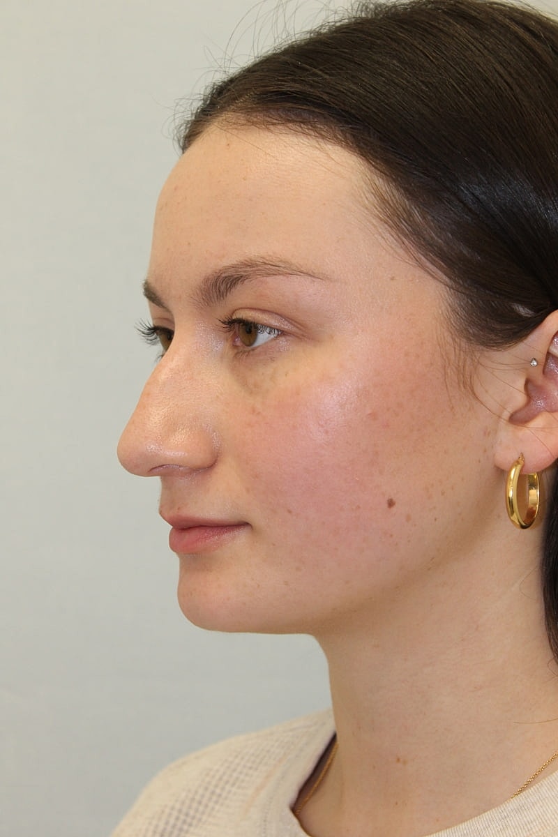 Rhinoplasty Before & After