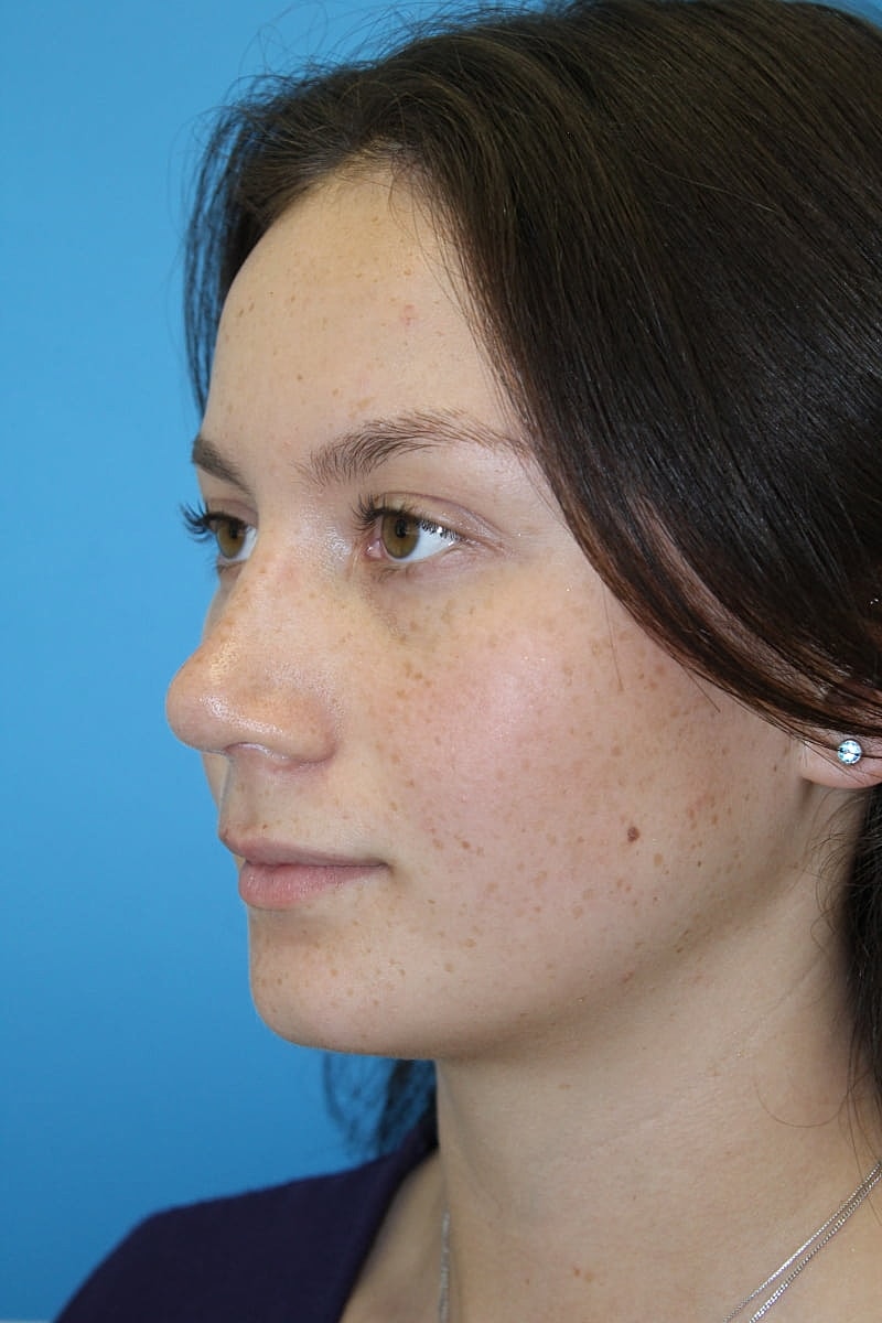 Rhinoplasty Before & After
