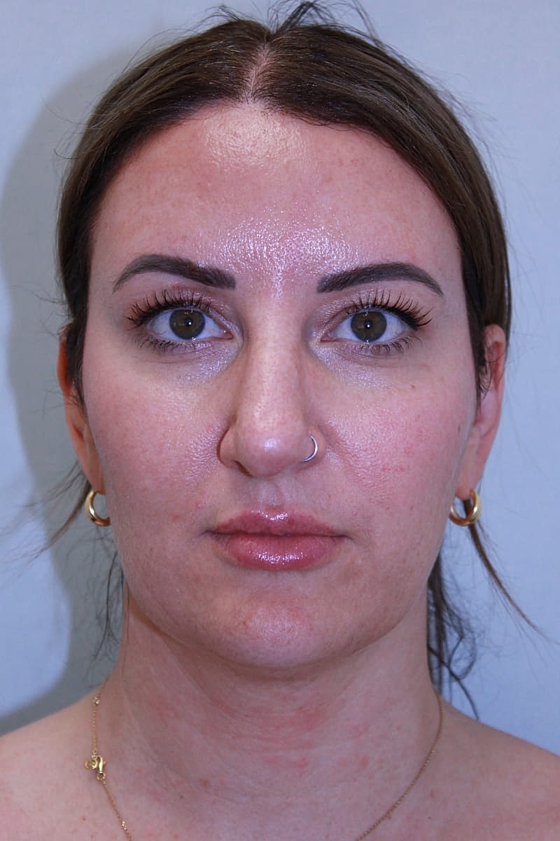 Rhinoplasty Before & After