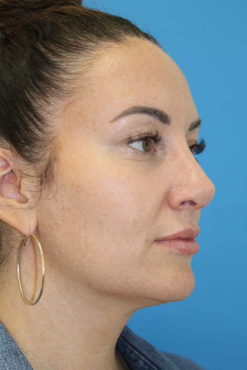 Rhinoplasty Before & After