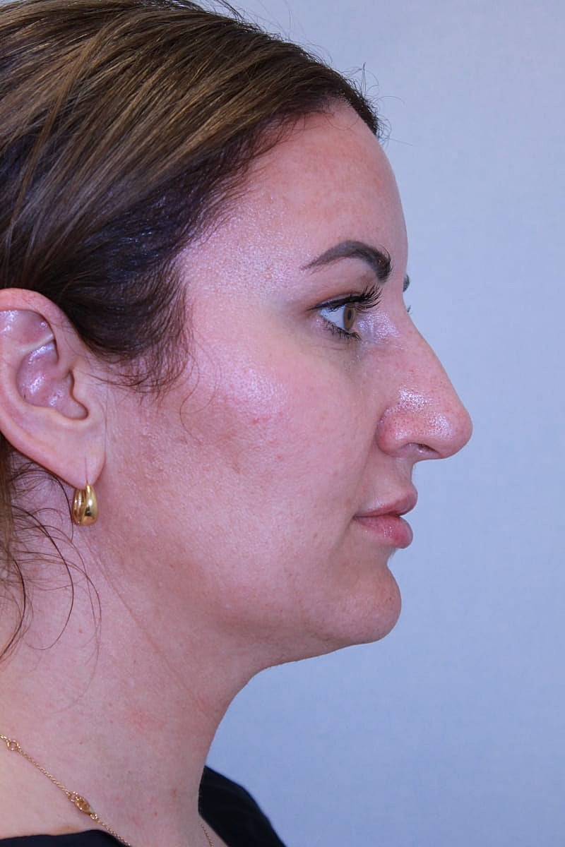 Rhinoplasty Before & After