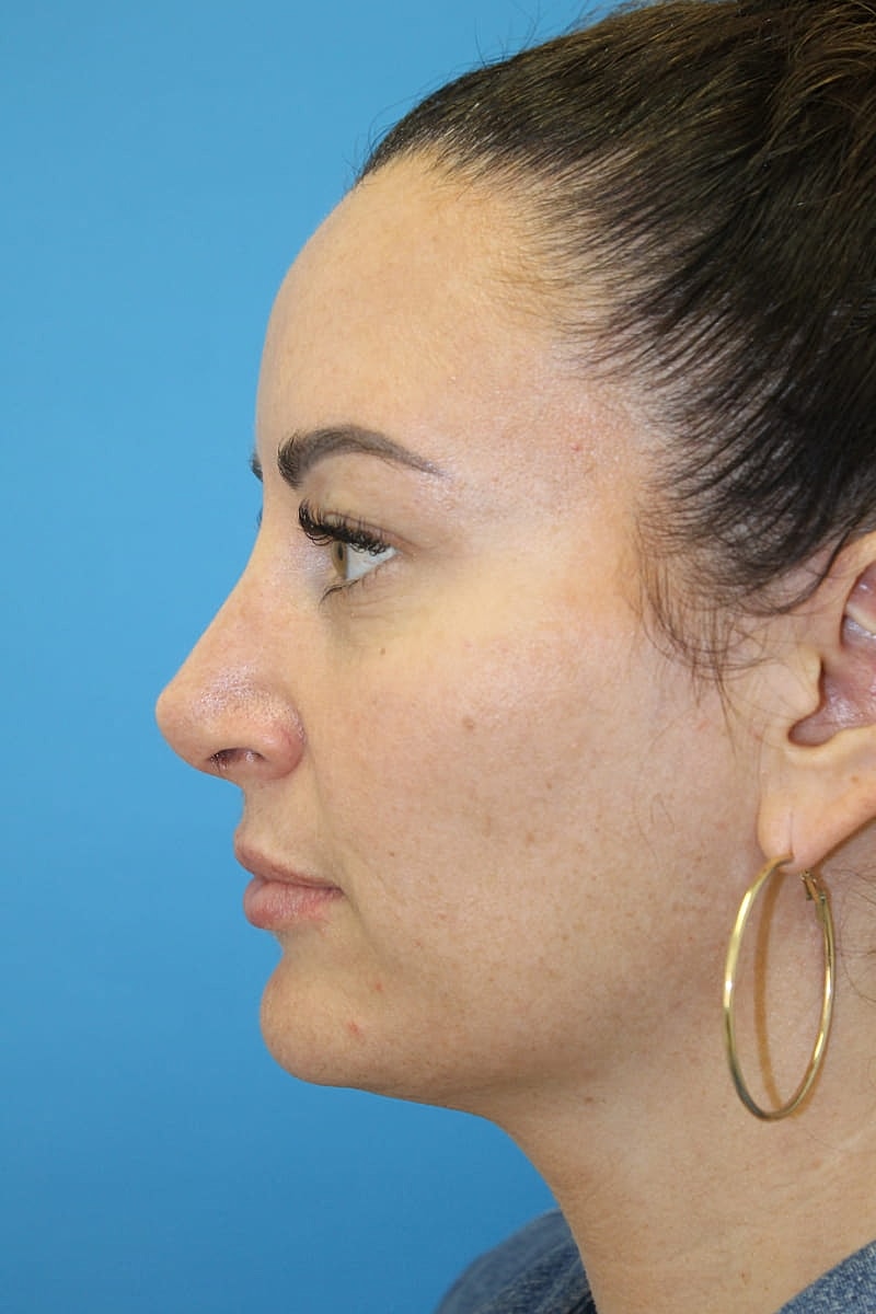 Rhinoplasty Before & After