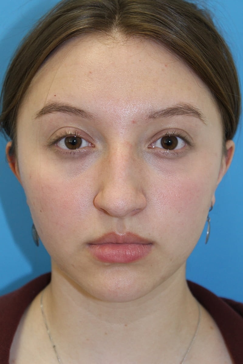 Rhinoplasty Before & After