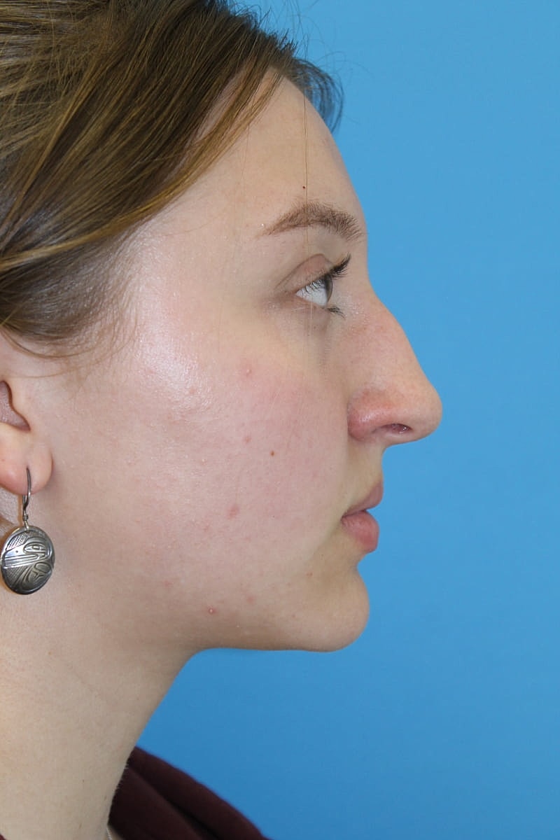 Rhinoplasty Before & After