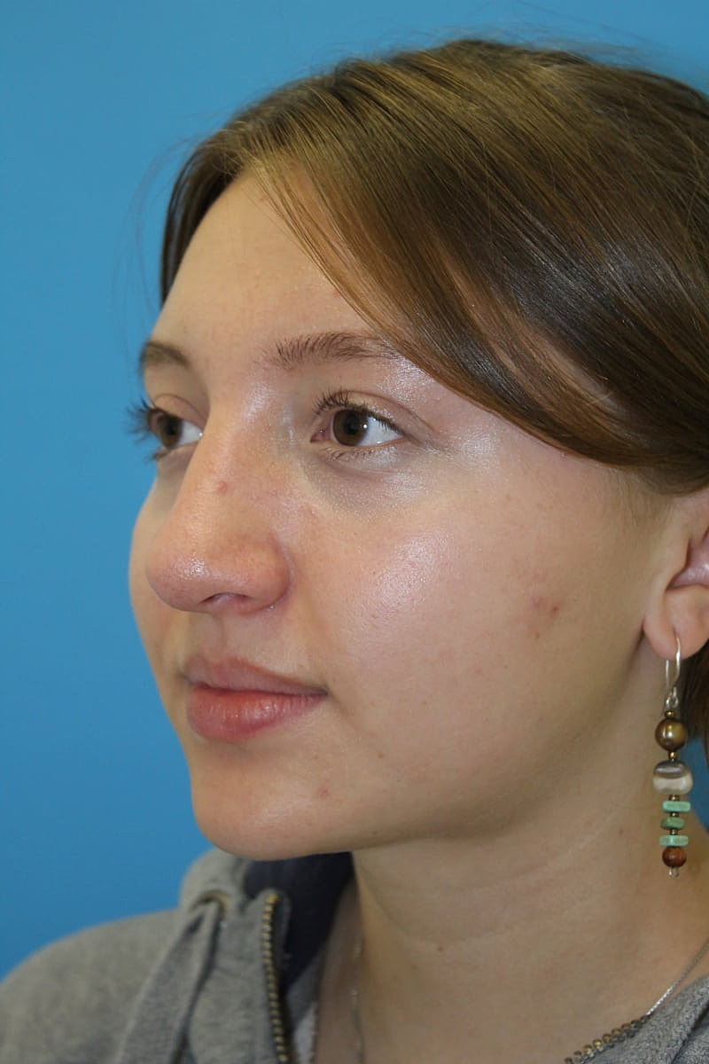 Rhinoplasty Before & After