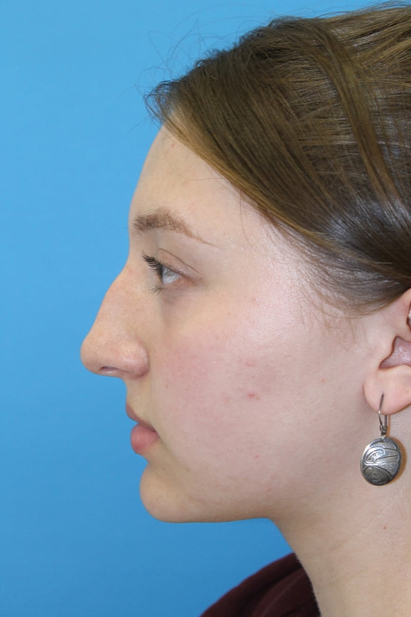 Rhinoplasty Before & After