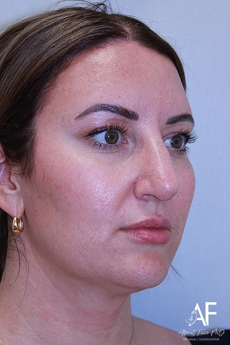Rhinoplasty Before & After