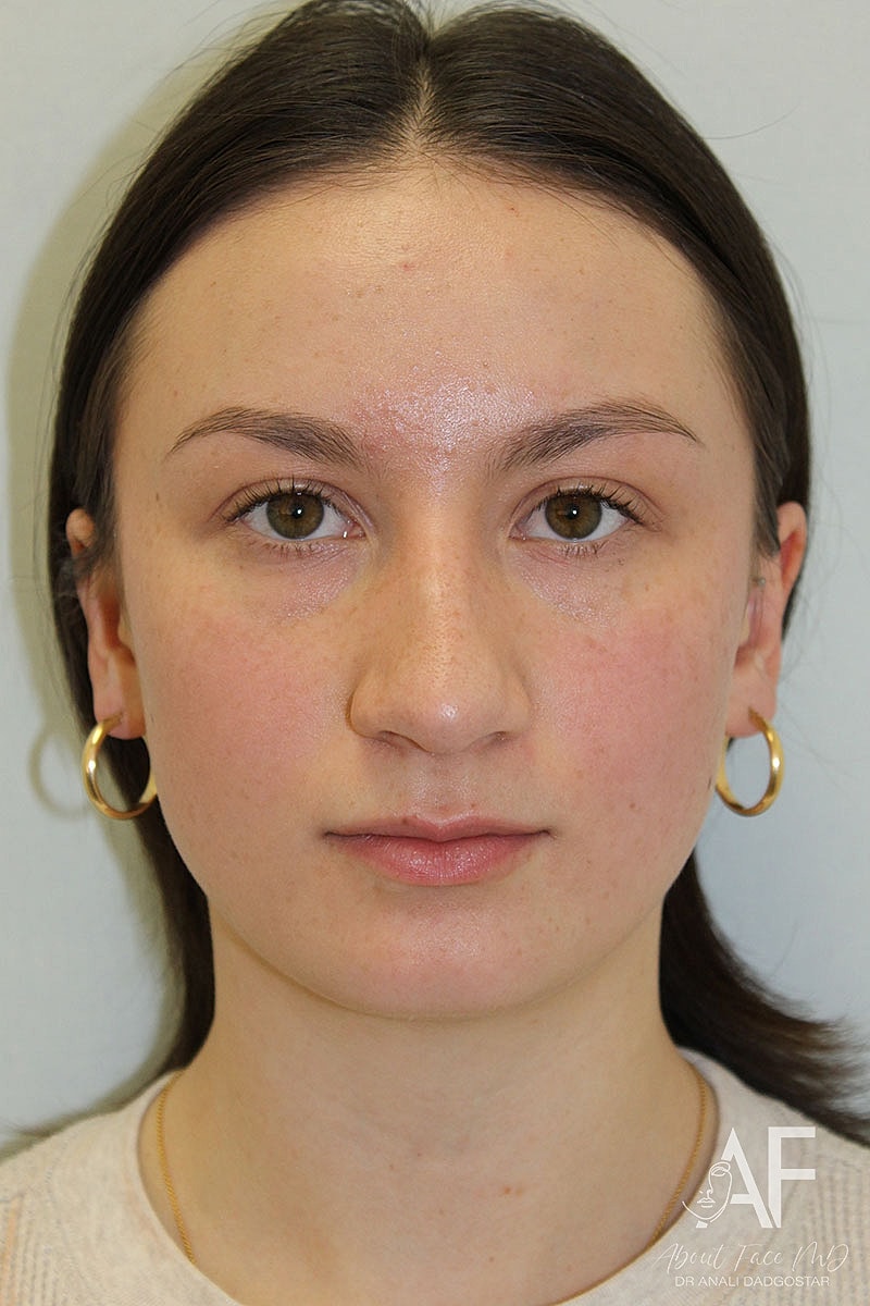 Rhinoplasty Before & After