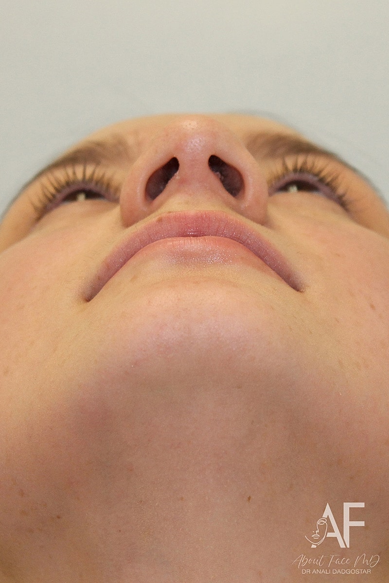 Rhinoplasty Before & After