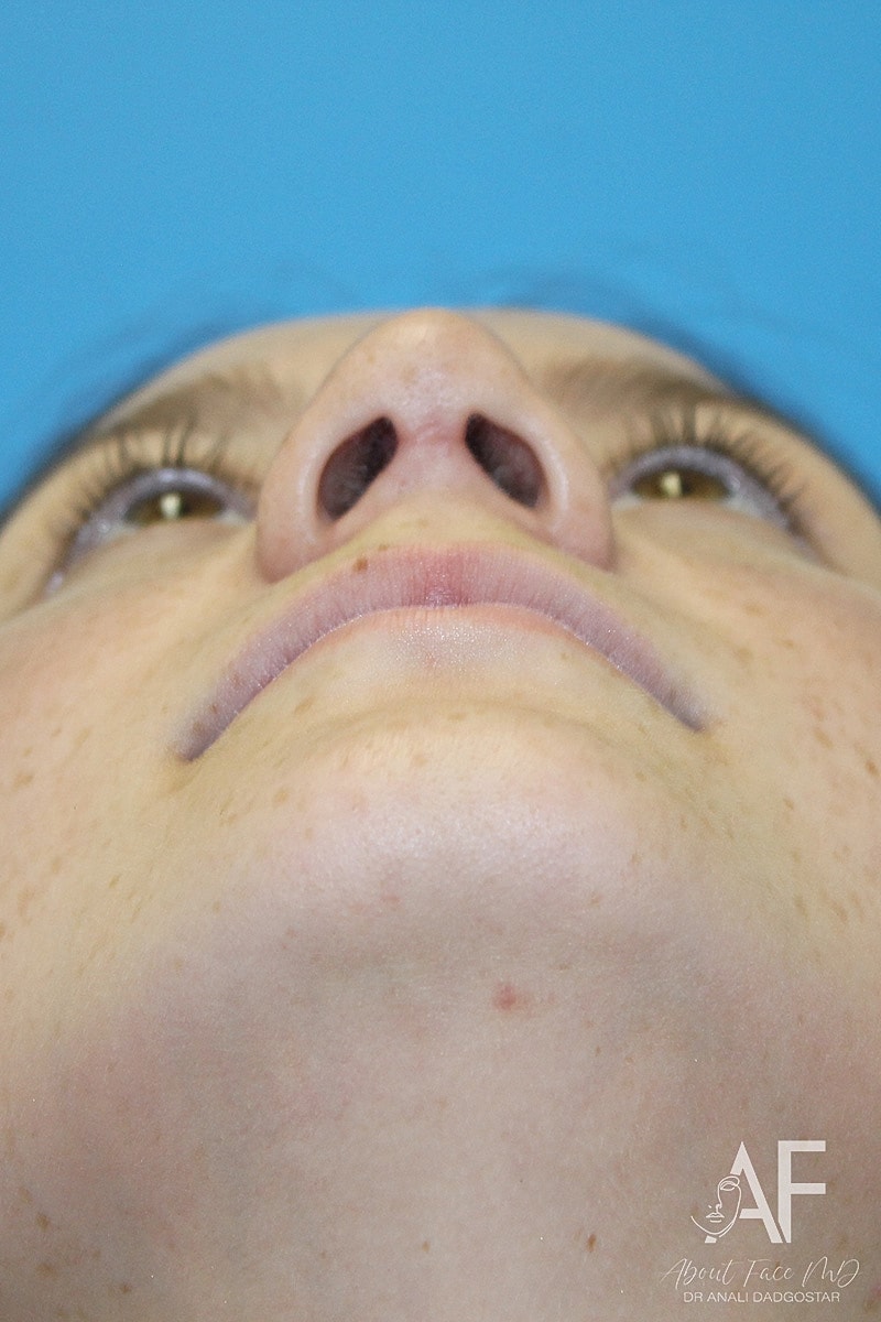 Rhinoplasty Before & After