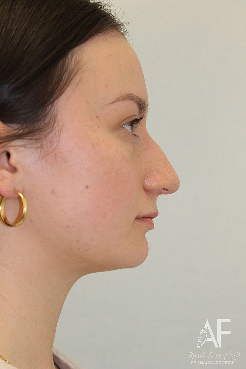 Rhinoplasty Before & After
