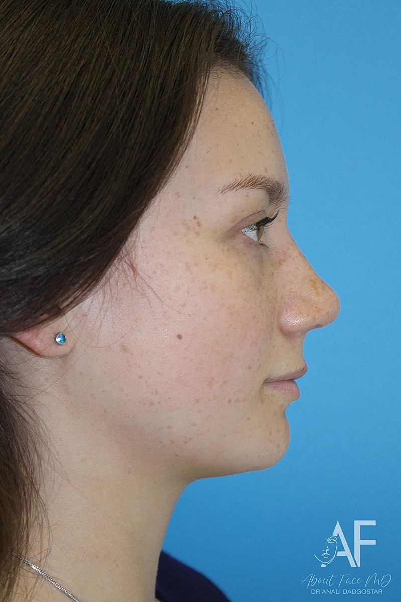 Rhinoplasty Before & After