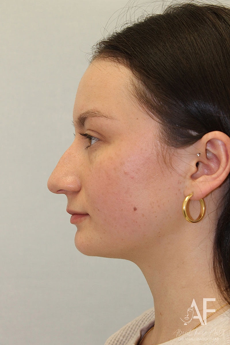 Rhinoplasty Before & After