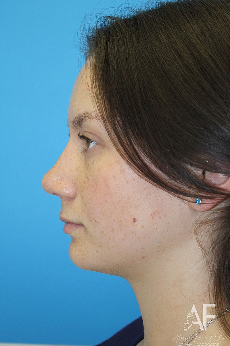 Rhinoplasty Before & After