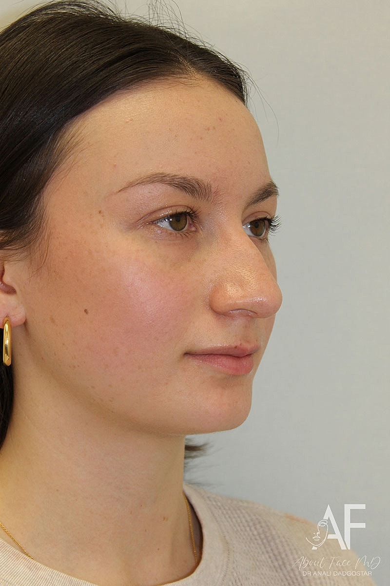 Rhinoplasty Before & After