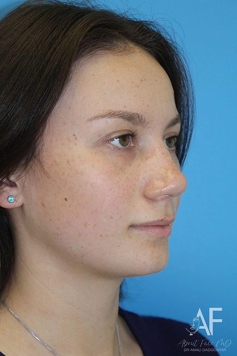 Rhinoplasty Before & After