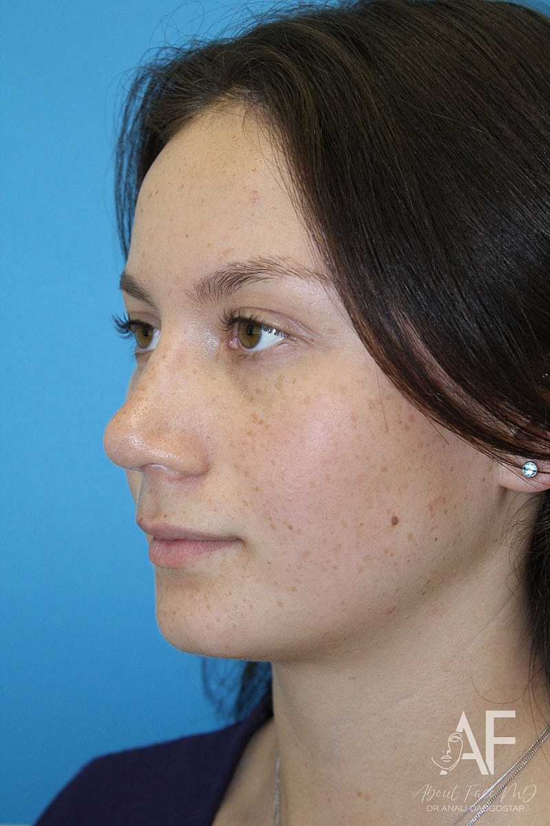 Rhinoplasty Before & After