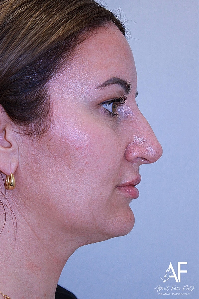 Rhinoplasty Before & After