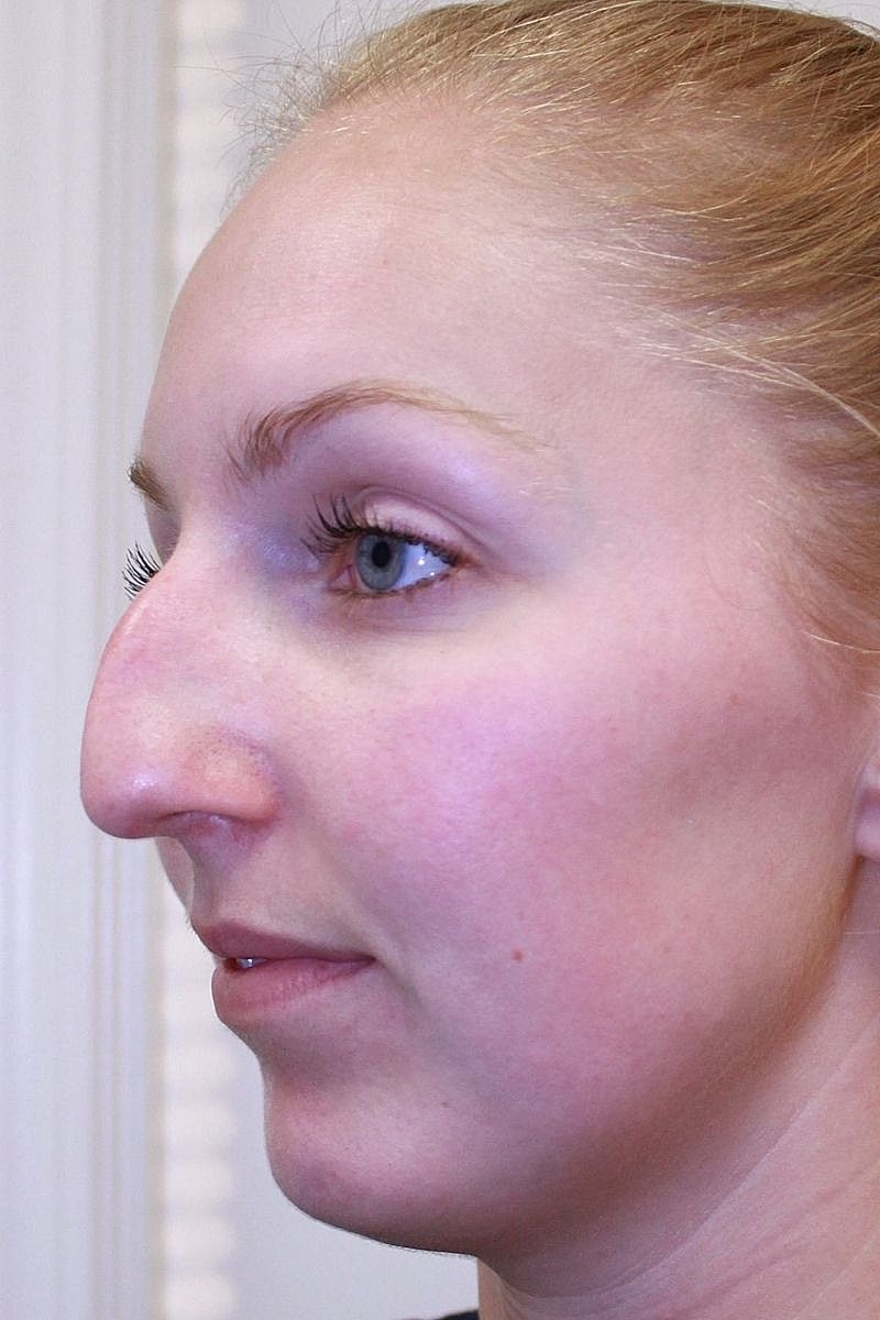 Profile view of a woman with prominent nose.