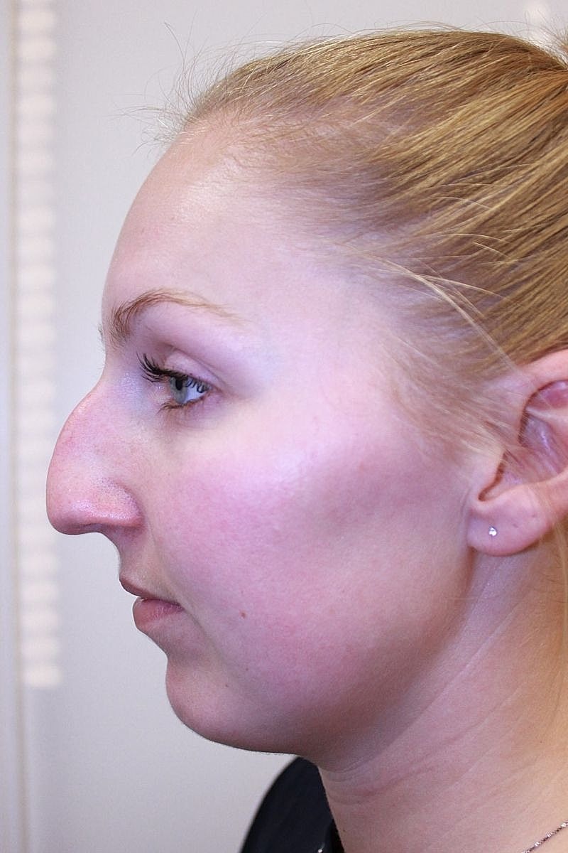 Profile view of a woman with prominent nose.