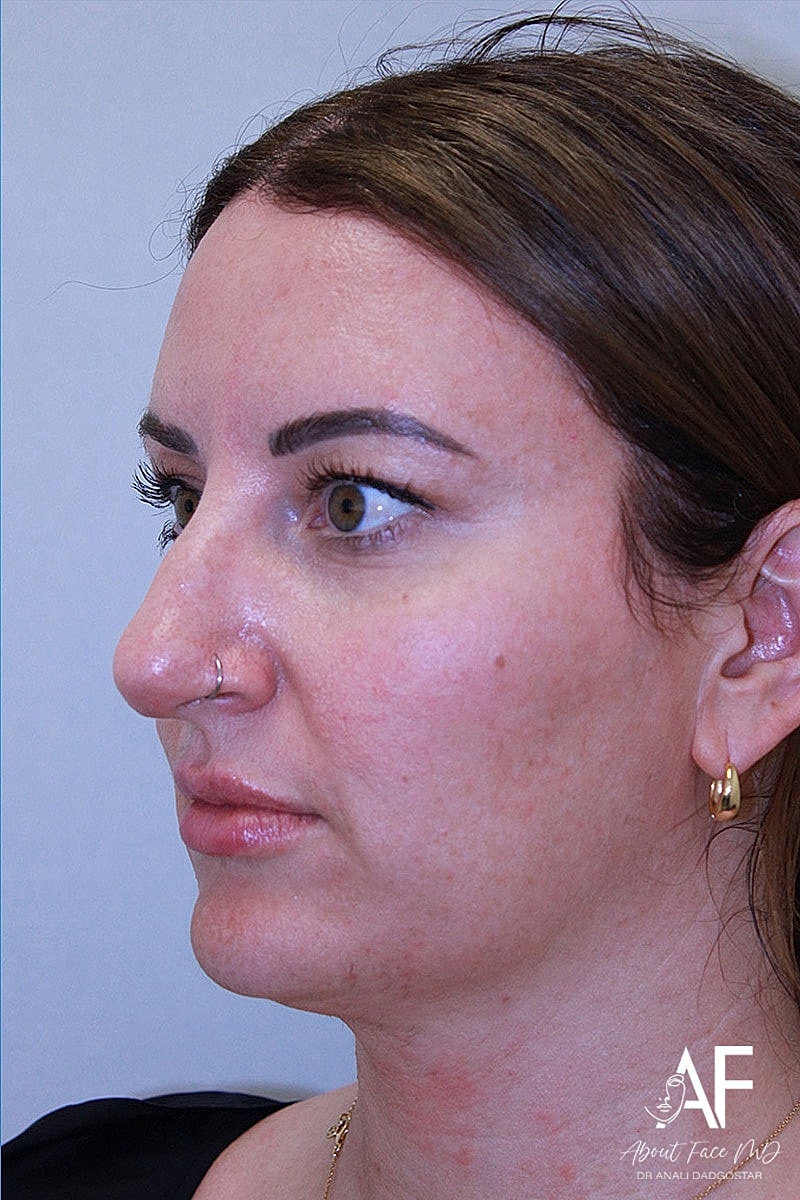 Rhinoplasty Before & After