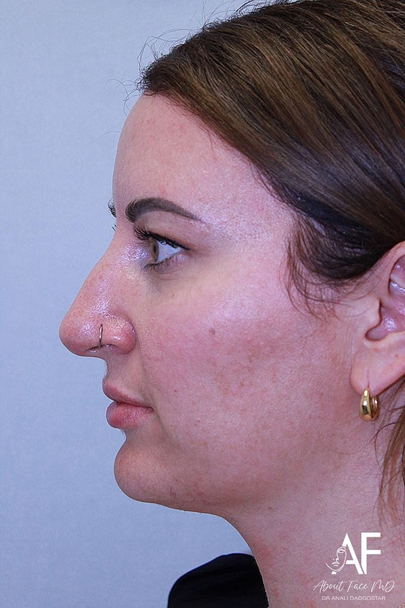 Rhinoplasty Before & After