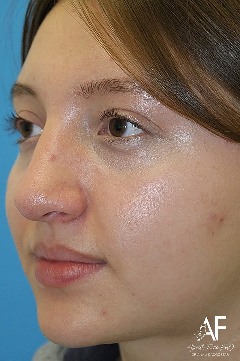 Rhinoplasty Before & After