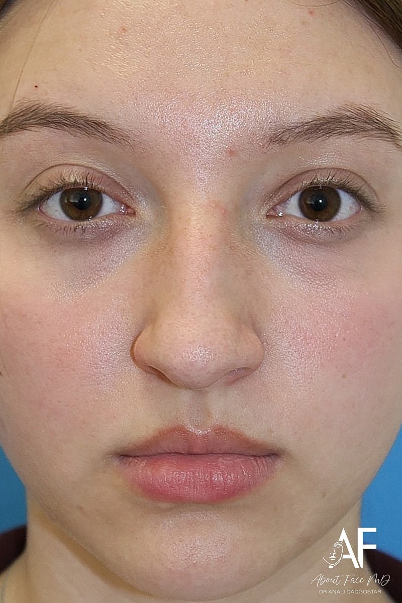 Rhinoplasty Before & After