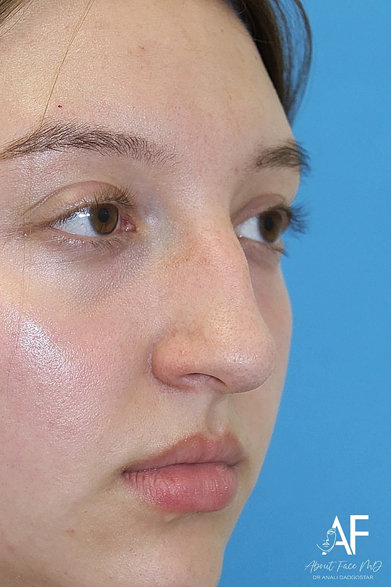 Rhinoplasty Before & After
