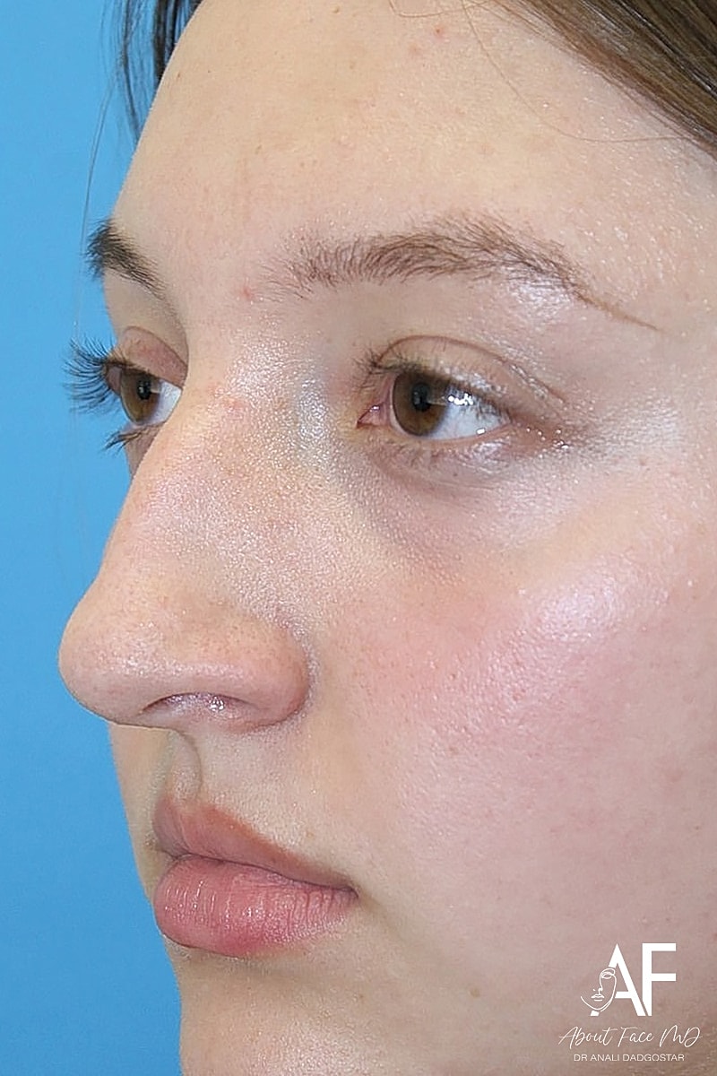 Rhinoplasty Before & After