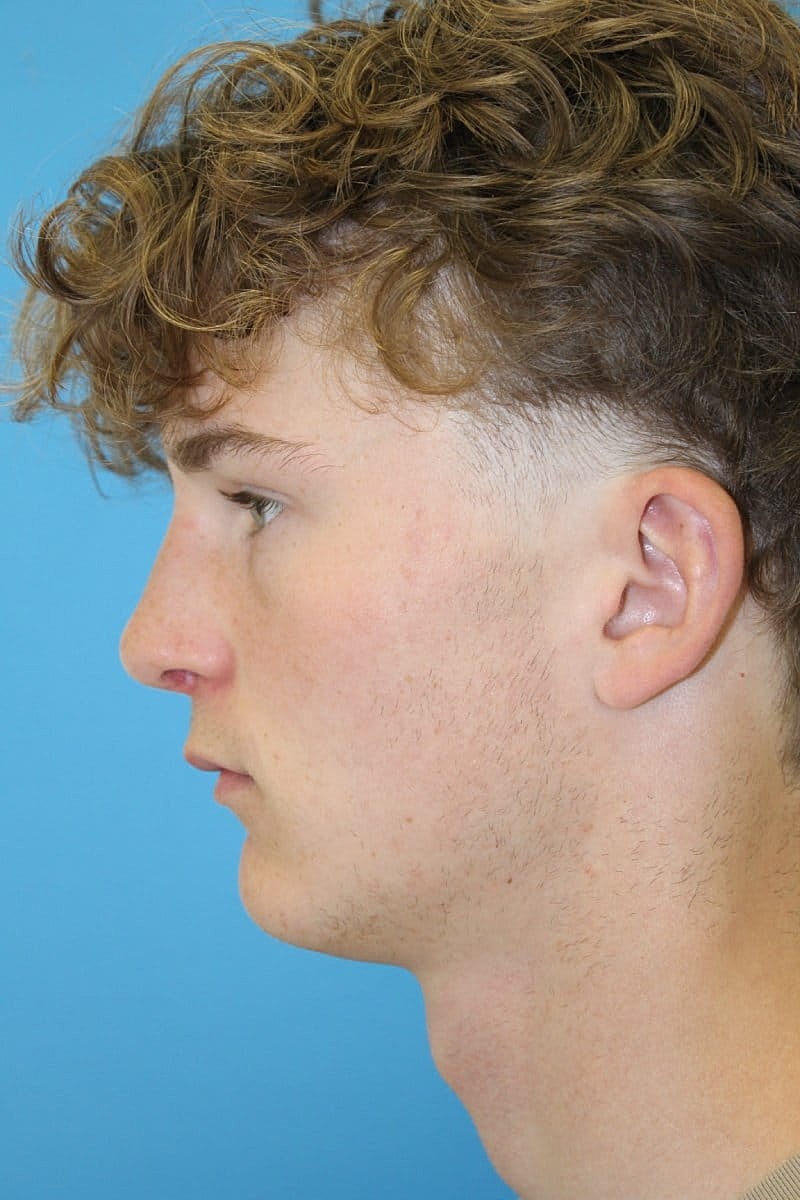 Otoplasty Before & After