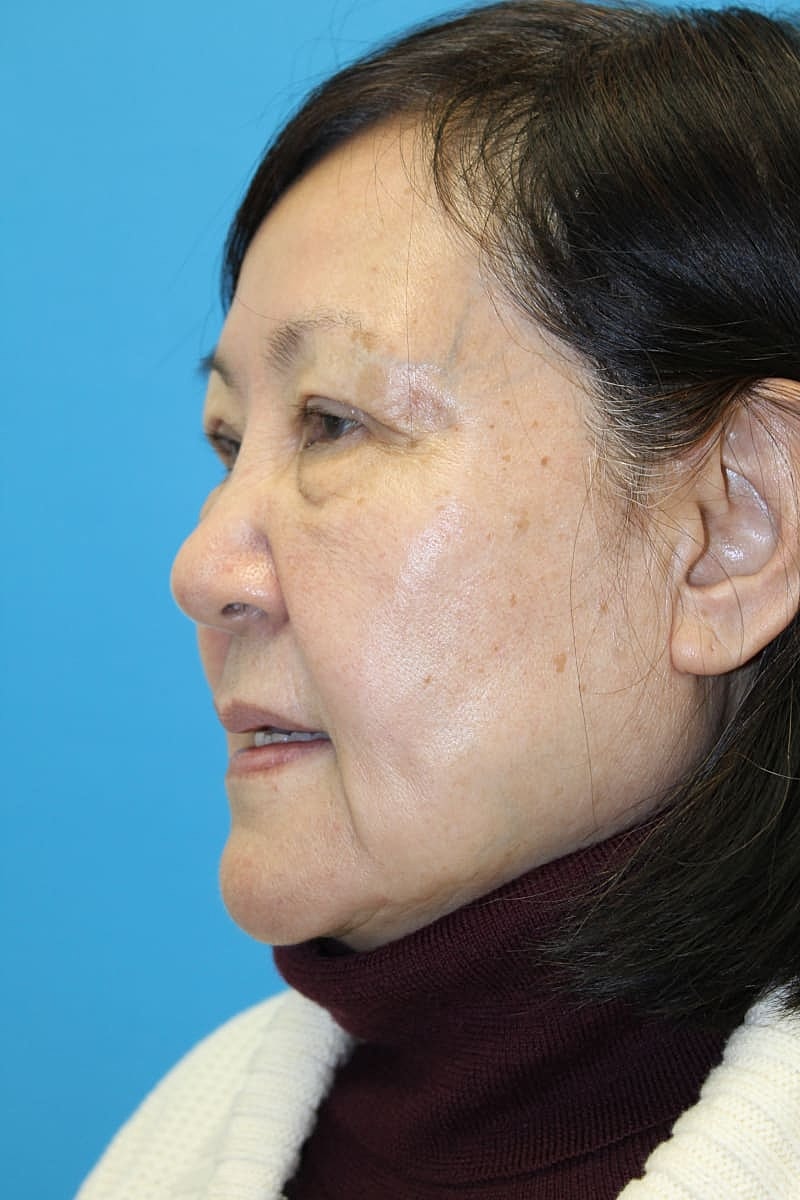 Upper Blepharoplasty Before & After