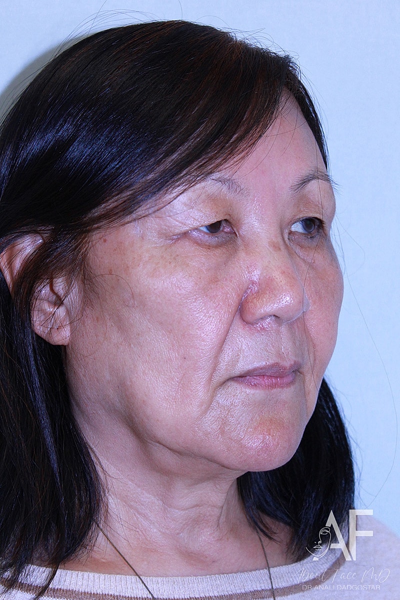 Upper Blepharoplasty Before & After