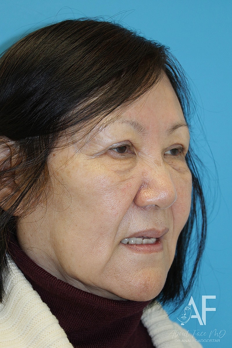 Upper Blepharoplasty Before & After