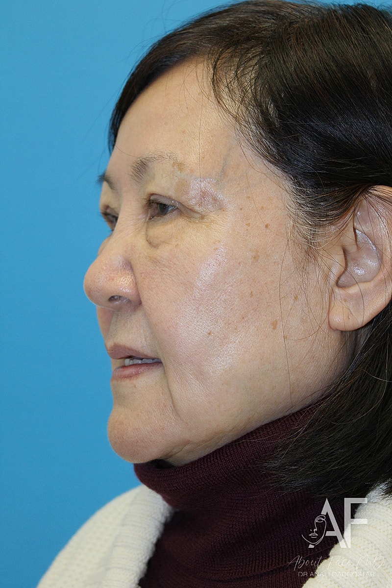 Upper Blepharoplasty Before & After